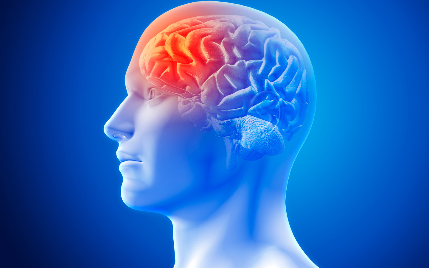 ICTUS, ¿Qué es?, síntomas, prevención