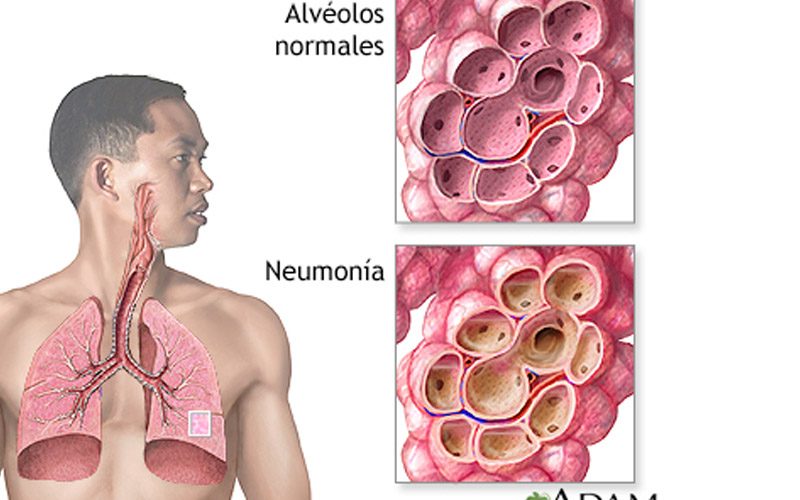 Neumonía ¿Qué es y cuales son sus síntomas?