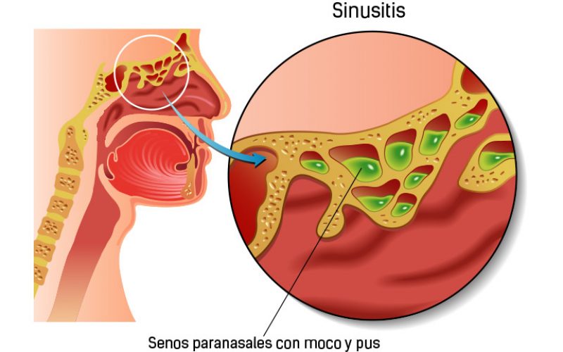 La sinusitis y sus síntomas