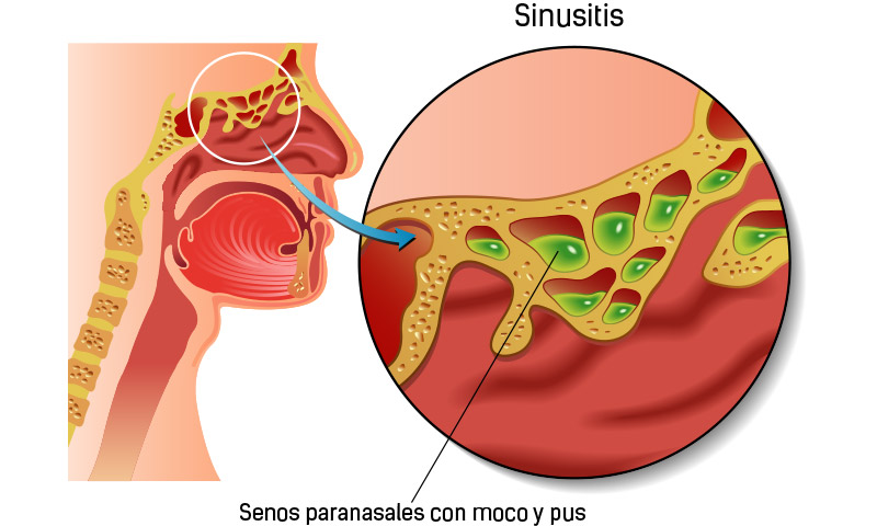 La Sinusitis